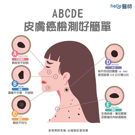 身體長誌|健康網》長痣＝皮膚癌？ 醫提7症狀：善用ABCDE原。